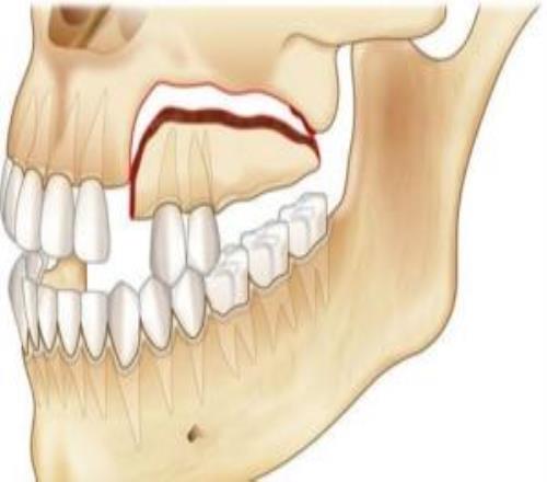 奇克牙槽骨骨折多顆牙齒脫落，媒體預(yù)計他近期無法進食和講話