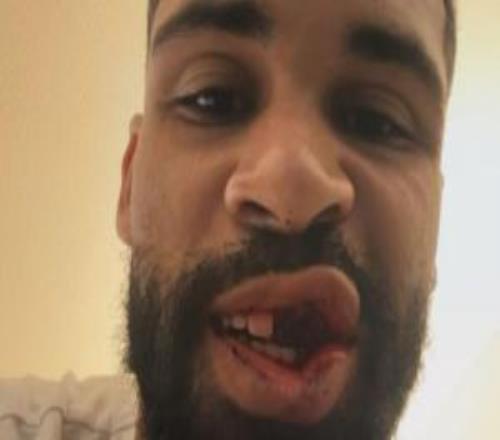 有點慘！奇克社媒報平安，曬自己多顆牙齒脫落照