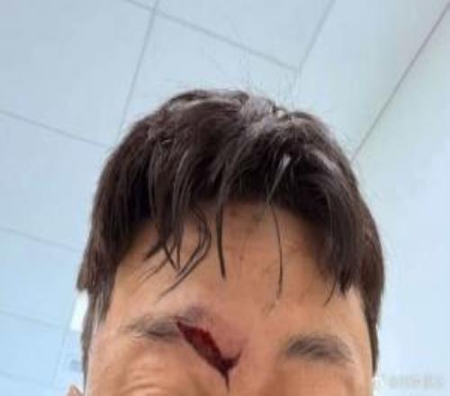 慎入！高準翼眉骨處裂開一道大口子，比賽中頭部相撞賽后已縫針