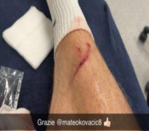 誤傷自己人！哈蘭德曬照：訓練中小腿被科瓦契奇踢出一道血痕