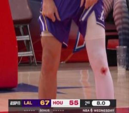 东契奇&库里膝盖出血之谜：不是药水而是地板擦伤留下的真实血迹