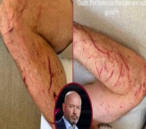 55岁希勒骑自行车时受伤：手臂、腿部多处割伤和擦伤