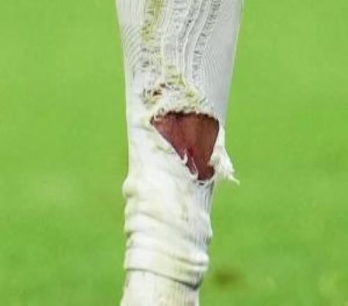 有點(diǎn)狠！塔蹬踏姆巴佩小腿染黃，姆巴佩小腿襪被踩破露出血痕