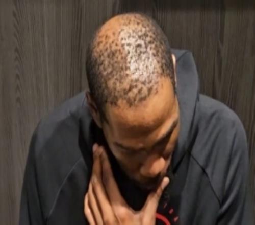 37歲還單身有原因！杜蘭特禿頂這么嚴(yán)重這發(fā)量找對象難啊