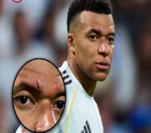 血灑球場！ESPN曬姆巴佩傷口圖，傷痕明顯有些腫