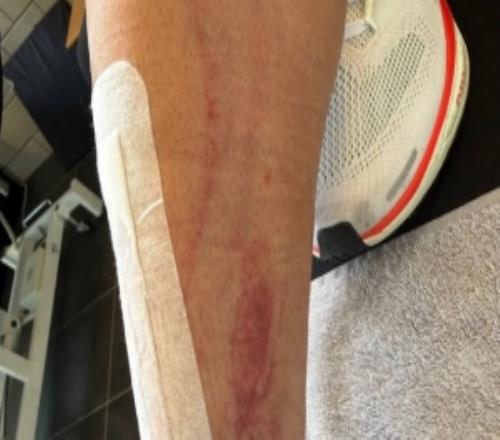 慎入！前德甲球員霍爾特比荷甲遭遇兇狠犯規(guī)，腳被劃開一道口子