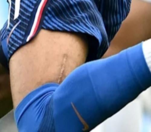 圖片報解釋奧利塞大腿傷疤：2023年歐青賽大腿肌肉嚴重撕裂而手術(shù)