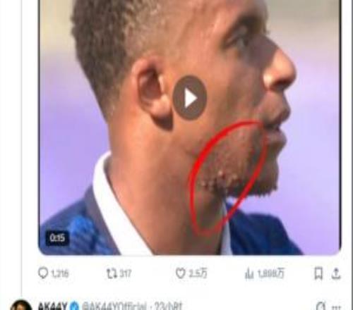 姆巴佩脸上长痘痘上热搜赛后照和采访均显示他皮肤正常