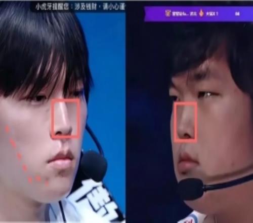 网友细扒Bin脸部变化细节:鼻梁变直变长脸颊软组织折叠变化