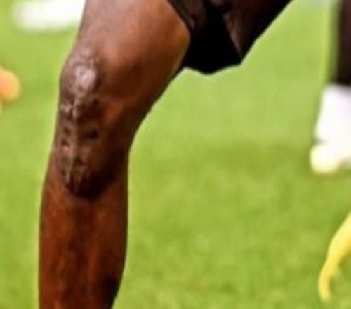 可怕的膝伤！博尼法斯曾两度ACL重伤+现又需做手术，膝盖伤痕累累