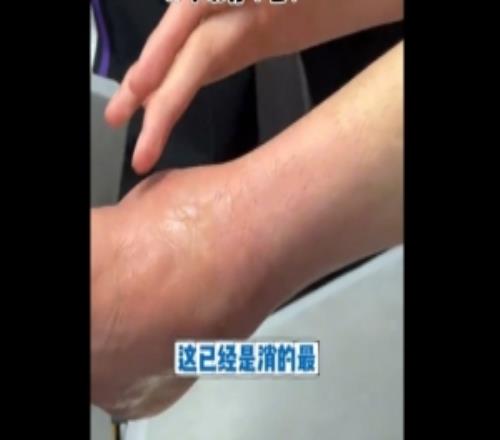 还没好又崴了！沈梓捷：和上次崴的同一只脚没上次严重就是肿痛