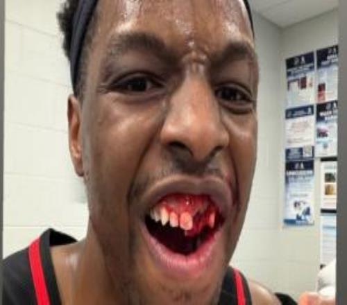 吓到！奥孔武原来是两颗牙被肘掉满嘴是血啊！