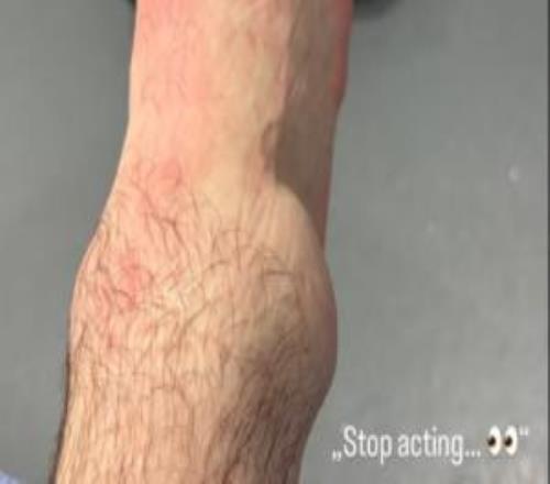 肿得跟鸡蛋一样大！利兹联中场斯塔赫晒照，脚踝被铲伤严重肿胀