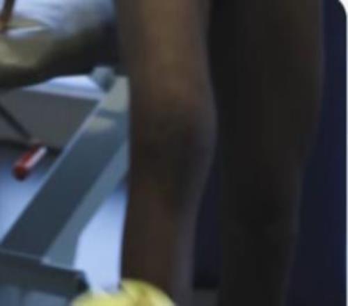 十字韧带+外侧半月板断裂！罗德里戈晒训练视频右腿肌肉萎缩明显